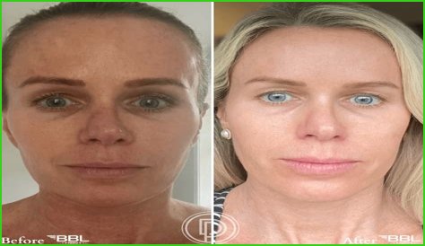 Rollie BBL Before And After Photo: Surgery Update 2023